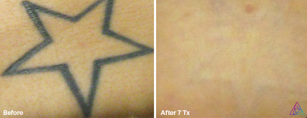Before and after tattoo removal
